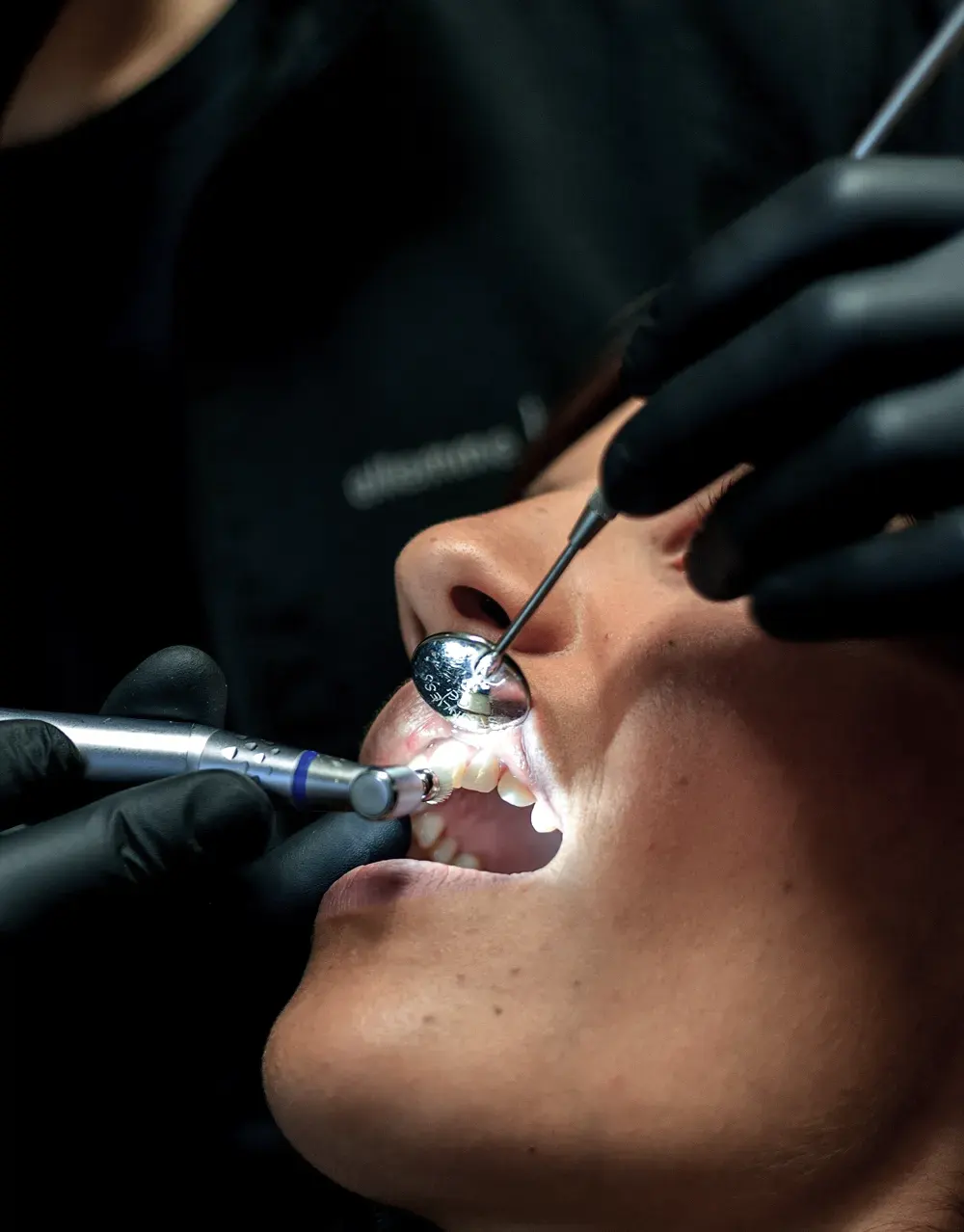 pulizia dei denti a viterbo